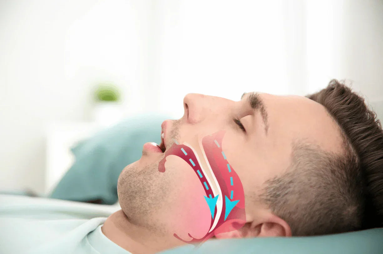 Man sleeping with obstructed airway diagram, showing sleep apnea and respiratory airflow