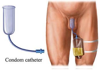 Condom catheter attached to male patient with urine drainage bag secured to thigh