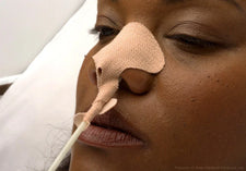 Adult woman with a nasogastric tube secured by a skin-tone nasal tube holder